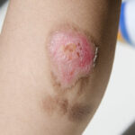 Injured_BurnChild Injured_BurnChild
