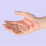 BurnHand